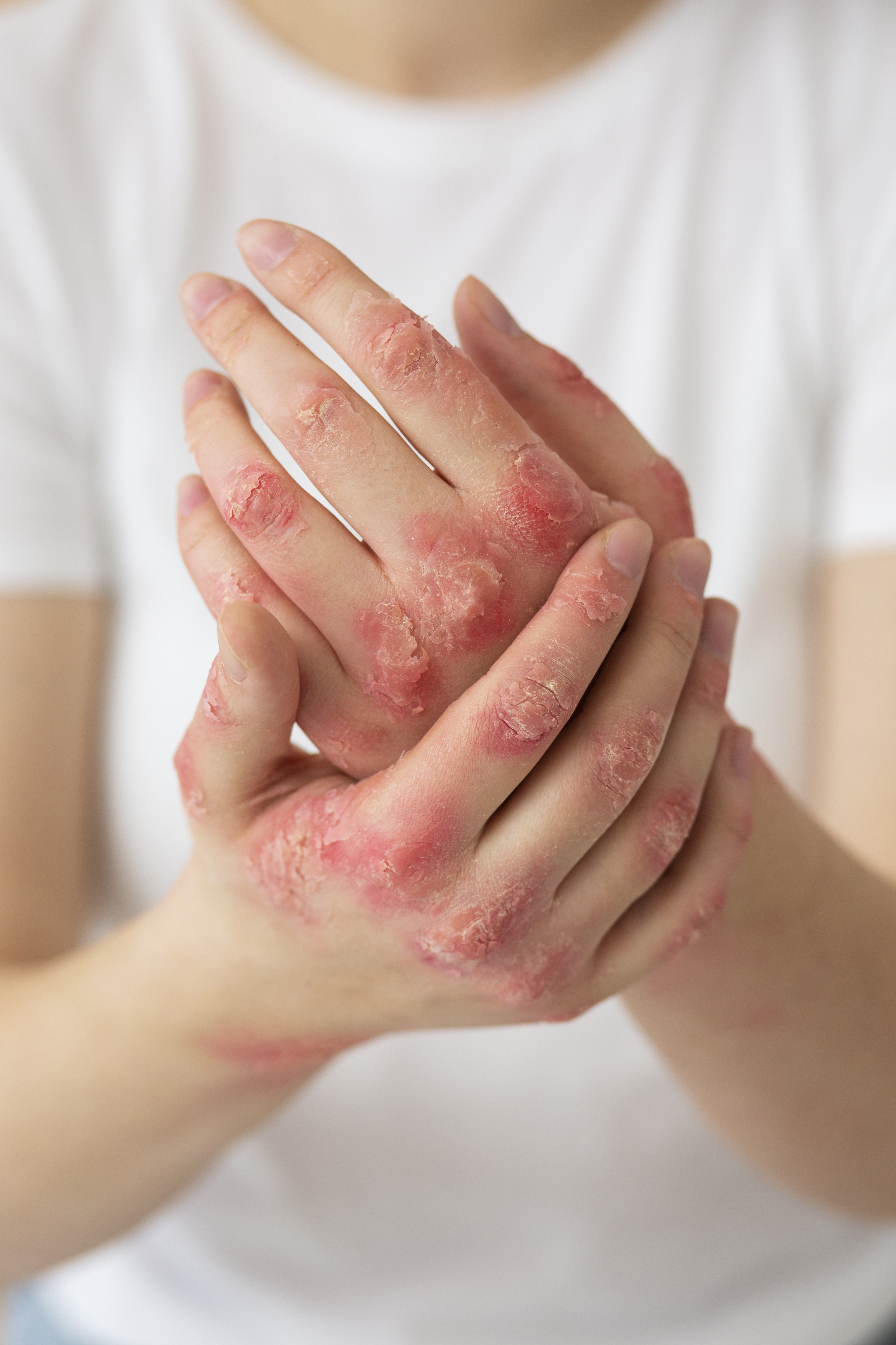 Infecções de pele por bactérias em academias